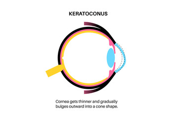 Poster - Cataract eye disease