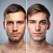 © lexmomot - Before and after skin treatment comparison showing clear and blemished skin on a man