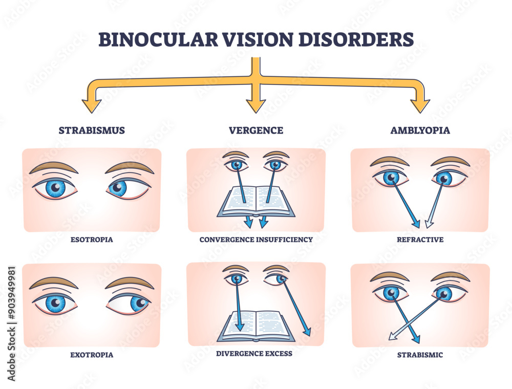 Binocular vision disorders with all eye defect examples outline diagram ...
