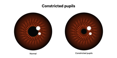 Constricted pupils eye diseases ophthalmology