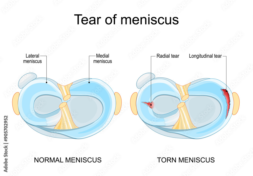 Meniscal tear. Torn meniscus. Knee injury. Stock Vector | Adobe Stock