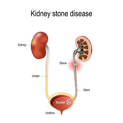 Kidney stone disease. Cross section of Ureter with Stone and Stent