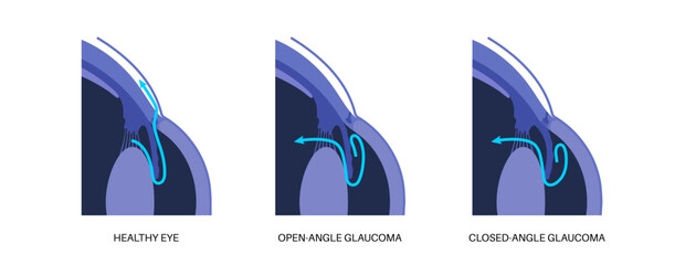 Wall Mural - Glaucoma eye disease