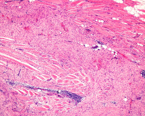 Poster - Muscle fibrosarcoma