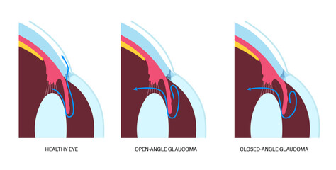 Wall Mural - Glaucoma eye disease