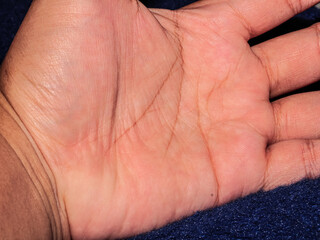 Closeup view of horizontal simian line on the palm of hand