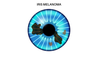 Canvas Print - Iris melanoma anatomy