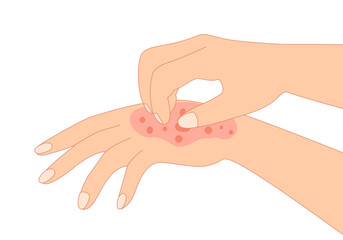 Poster - rash skin on hand. scratching arm in red spot, dermatitis allergy symptom skin disease.