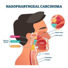 Poster - Nasopharyngeal carcinoma tumor, illustration labeled diagram, transparent background. Medical nose, mouth and throat cross section scheme with problem area. Health care educational information.