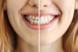© EdNurg - A closeup of a teenager smile, showing metal brackets and teeth before and after orthodontic treatment