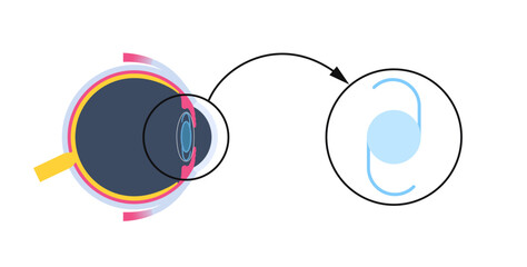 Sticker - Intraocular lens poster