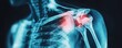 © Rattanathip - X-ray image of painful shoulder joints highlighting inflammation in the upper body. Medical and healthcare concept.