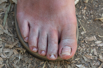 Woman foot showing dry skin after hiking in flip flops