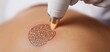 © Natalia - Close-up of laser removing intricate tattoo from a person's skin, subtle smoke effect, soft lighting, detailed skin texture, Tattoo removal, skincare advancement concept