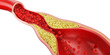 © Anusorn - High Blood Cholesterol, Thickened Arteries and Veins, Red Blood Cells, 3d illustration.