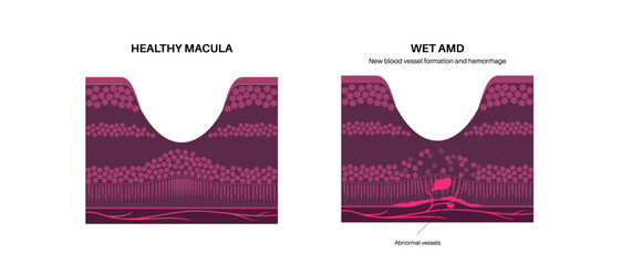 Sticker - Macular degeneration poster