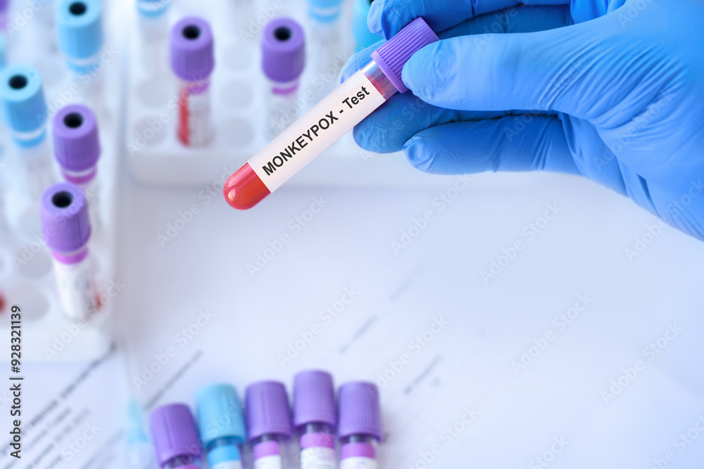 Doctor holding a test blood sample tube with Monkeypox virus (MPXV ...