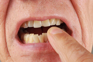 Man demonstrating his two front Incisors teeth that are chipped