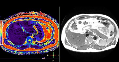 Wall Mural - An MRI PET scan of the abdomen in axial view provides a detailed cross-sectional image, helping to detect abnormalities with high precision.