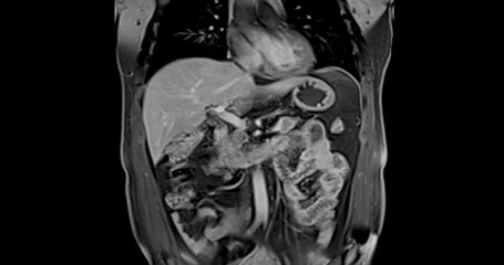 Wall Mural - MRI abdomen coronal views are particularly useful for assessing liver, kidneys, and other abdominal organs with precision.