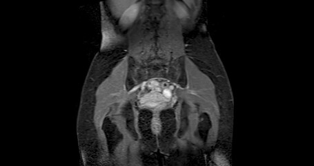 Wall Mural - MRI abdomen coronal views are particularly useful for assessing liver, kidneys, and other abdominal organs with precision.