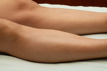 Woman's legs with dry skin that is ashamed.