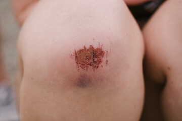 the wound on the girl's knee is a close-up