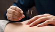 © ldelfoto - Acupuncture treatment