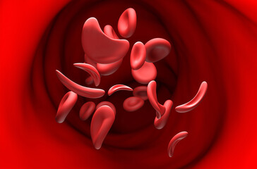 Sickle cell anaemia - section view 3d illustration