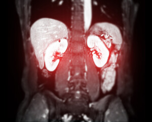 Wall Mural - MRI abdomen coronal views are particularly useful for assessing liver, kidneys, and other abdominal organs with precision.