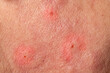 © Alessandro Grandini - Close up of irritated skin showing redness and inflammation