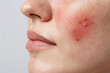 © Sunday Cat Studio - Close-up of a woman's face showing an acne spot on her cheek, highlighting skin texture and blemish treatment needs.