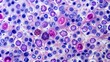© Man888 - Microscopic view of abnormal lymph node tissue with distinctive follicular pattern, characteristic of follicular lymphoma, a type of non-Hodgkin lymphoma cancer.