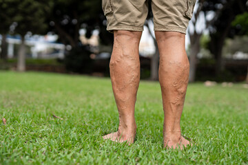 Elderly Man's Bare Legs with Varicose Veins in a Park, Standing on Green Grass