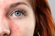 © Alessandro Grandini - Young woman showing symptoms of rosacea on her face
