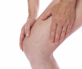 Canvas Print - Woman suffering from varicose veins on white background, closeup