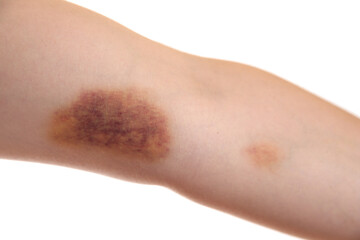 Canvas Print - Woman with bruise on arm against white background, closeup