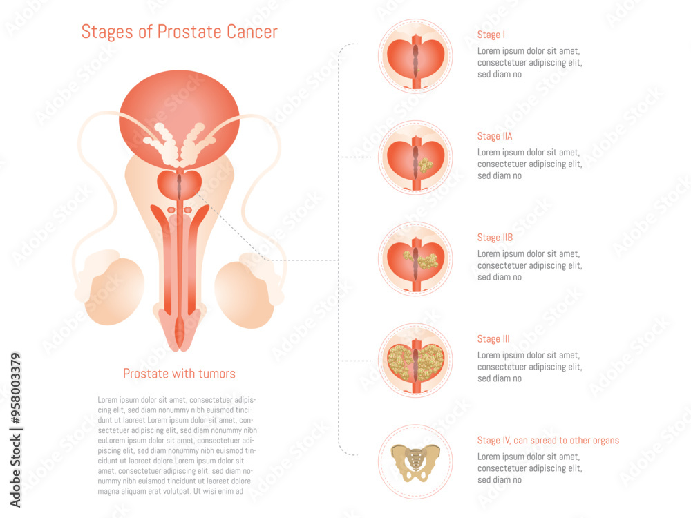 0711_cancerDetailed illustration depicting the different stages of prostate cancer, from early to advanced stages. The image includes a representation of the prostate with tumors in var_prostata_eltos