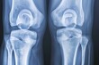 © EnigmaEasel - Visualizing Arthritis in Knee Joints Through X-Ray Imaging: Understanding the Impact on Joint Health, Cartilage Loss, and Mobility Challenges