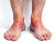 © KaroMaeckle - Close-up images showing swollen and inflamed feet with noticeable redness, representing medical conditions such as edema, gout, or injury.