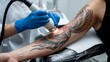 © D-point - Professional tattoo removal process: laser treatment on arm with colorful phoenix design