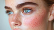 © Wararat - Close-up images of individuals with rosacea, focusing on the characteristic redness across the cheeks, nose, chin, and forehead.