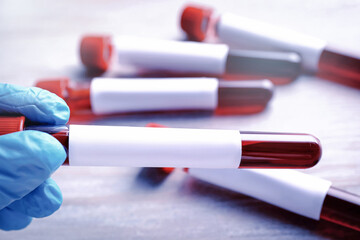 Laboratory worker holding test tube with blood sample and blank label over table, closeup. Medical analysis