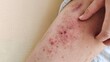 © Rung Kh - portrait the rash, hives, allergy and inflammation skin, reaction and urticaria, scar and acne, irritation and dermatitis, infection and eczema, dermatology and allergic on the leg of the woman.