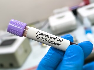 Ammonia level test for the diagnosis of Urea Cycle Disorder (UCD).