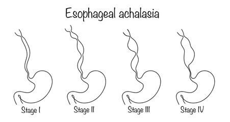 Wall Mural - Esophageal achalasia