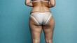 © Yeivaz - Woman with visible cellulite on her thighs and buttocks on blue background. Overweight liposuction