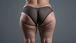 © Yeivaz - Woman with visible cellulite on her thighs and buttocks on gray background. Overweight liposuction
