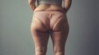 © Yeivaz - Woman with visible cellulite on her thighs and buttocks on gray background. Overweight liposuction
