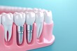 © Autaporn - Close-up of dental implants with realistic artificial teeth in a pink model for educational and professional purposes.